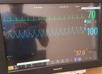 Philips IntelliVue MX800 Monitor 865240 W/ FMS