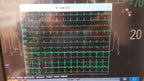 Philips IntelliVue MMX Module 867036 12 Lead ECG Biomed Tested