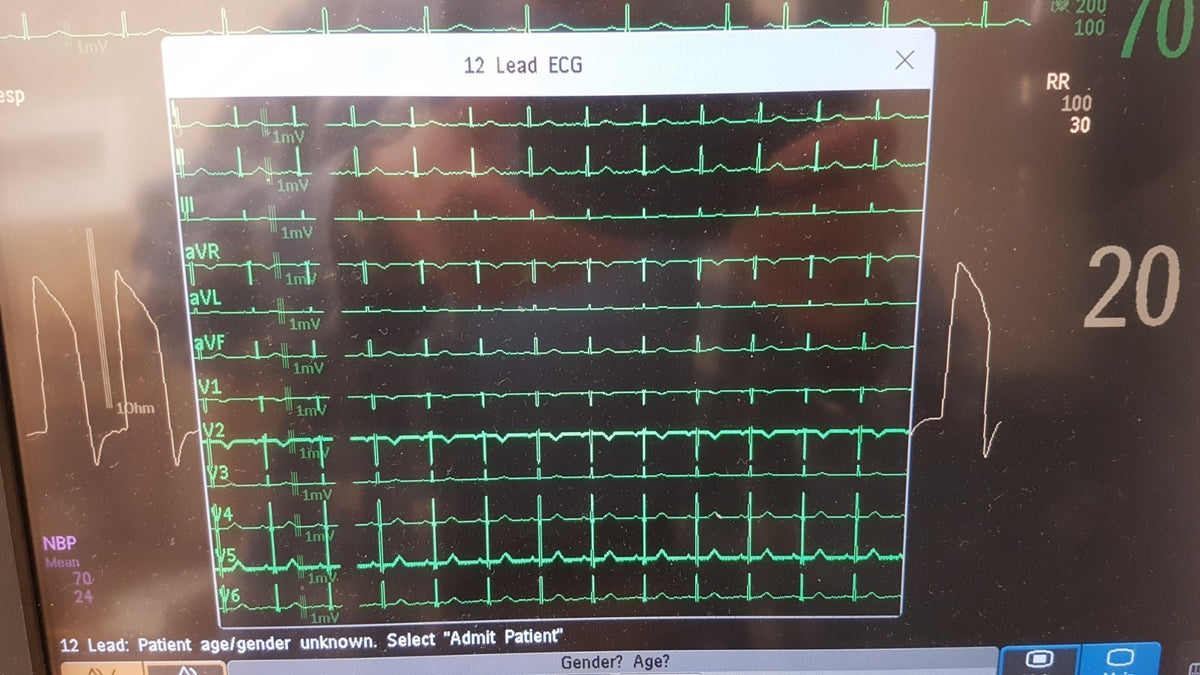 Philips IntelliVue MMX Module 867036 12 Lead ECG Biomed Tested