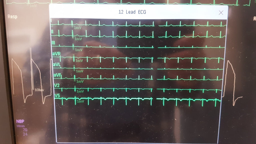 Philips IntelliVue MMX Module 867036 12 Lead ECG Biomed Tested