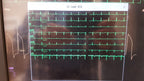 Philips IntelliVue MMX Module 867036 12 Lead ECG Biomed Tested