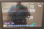 Philips IntelliVue MX800 Monitor 865240