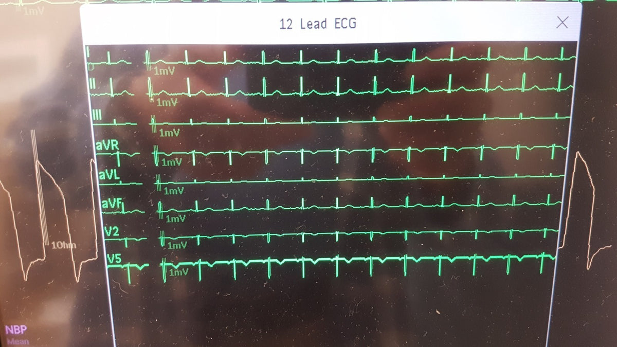Philips IntelliVue MMX Module 867036 12 Lead ECG Biomed Tested