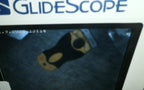 Verathon Glidescope 0800-0543 HDMI Smart Cable W/ LoPro S1, S2, S2.5, S3